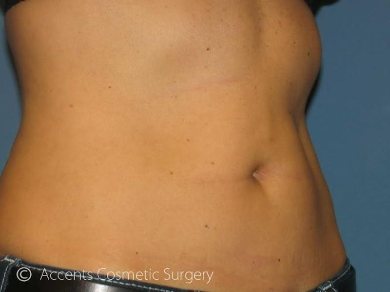 Thermage Before & After Gallery - Patient 208646 - Image 2