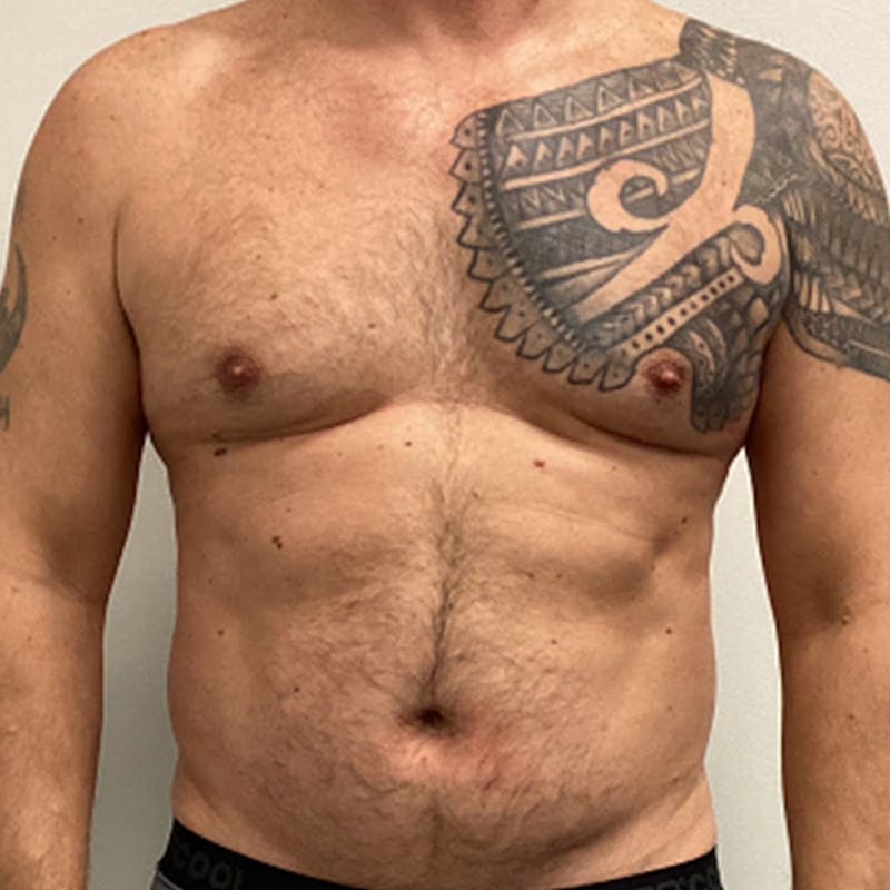 Vaser Lipo Before & After Gallery - Patient 273816 - Image 1