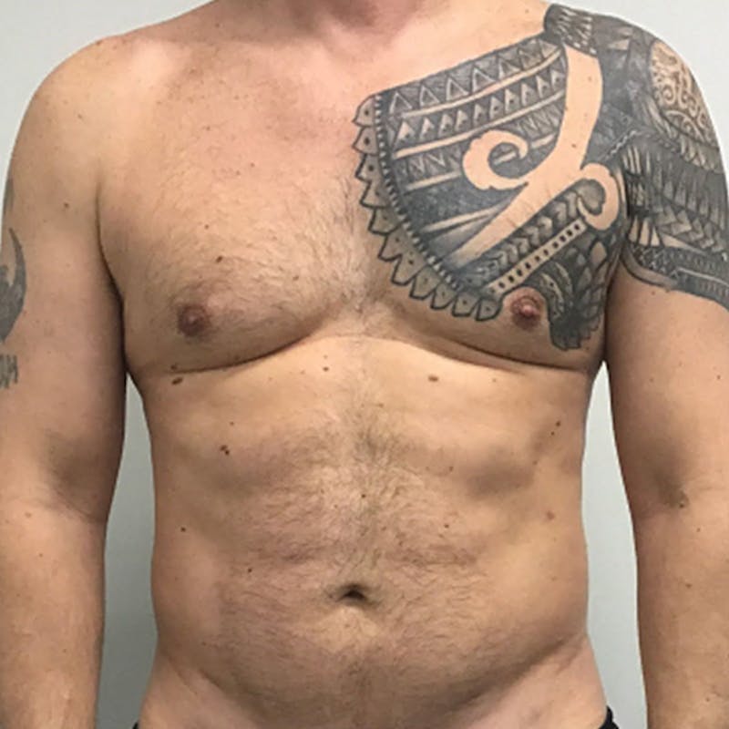 Vaser Lipo Before & After Gallery - Patient 273816 - Image 2