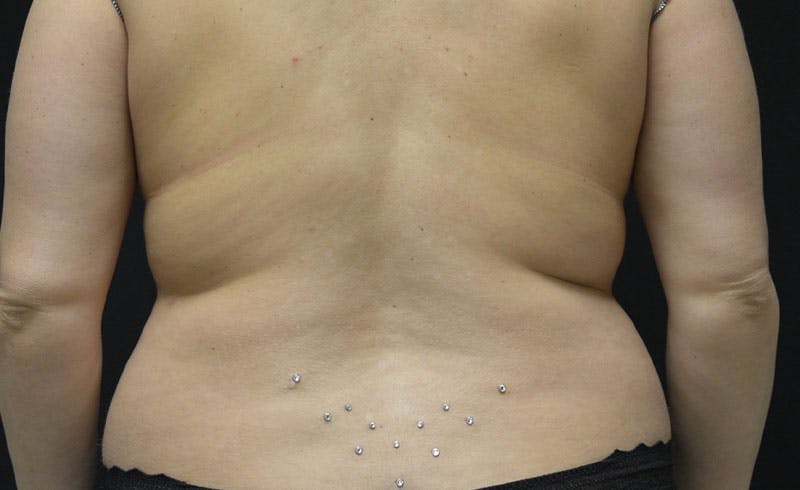 Bra Line Before & After Gallery - Patient 130021 - Image 1