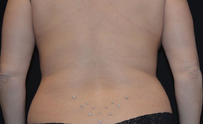 Bra Line Before & After Gallery - Patient 130021 - Image 2