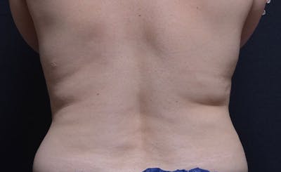 Bra Line Before & After Gallery - Patient 290290 - Image 1