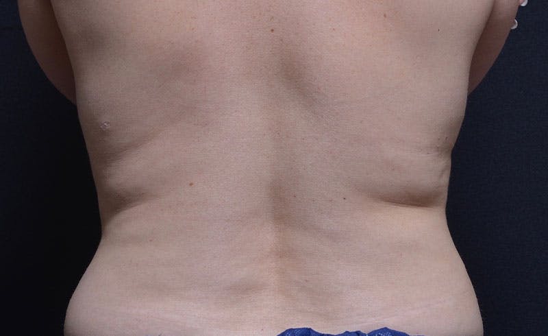 Bra Line Before & After Gallery - Patient 290290 - Image 1