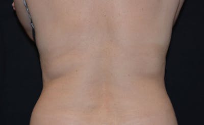 Bra Line Before & After Gallery - Patient 290290 - Image 2