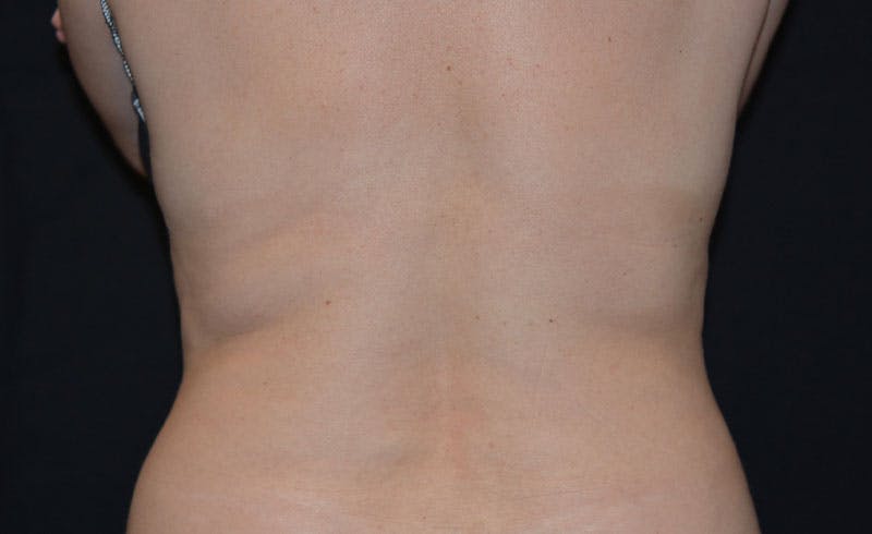 Bra Line Before & After Gallery - Patient 290290 - Image 2