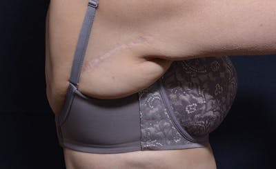 Bra Line Before & After Gallery - Patient 326532 - Image 1