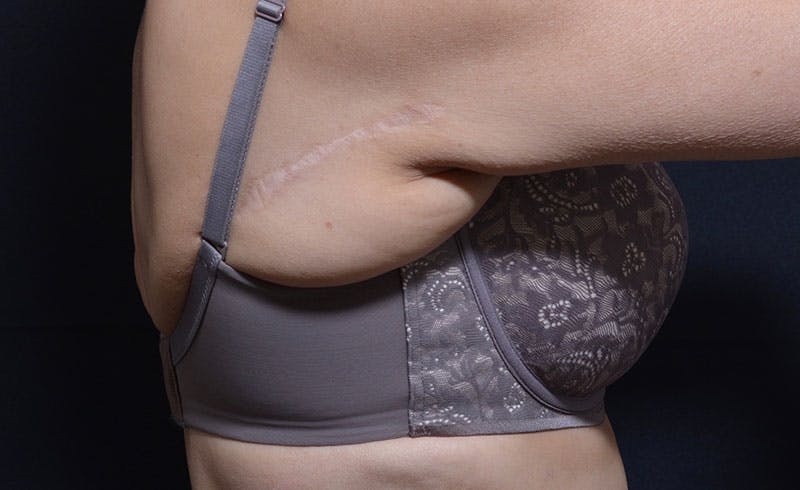 Bra Line Before & After Gallery - Patient 326532 - Image 1