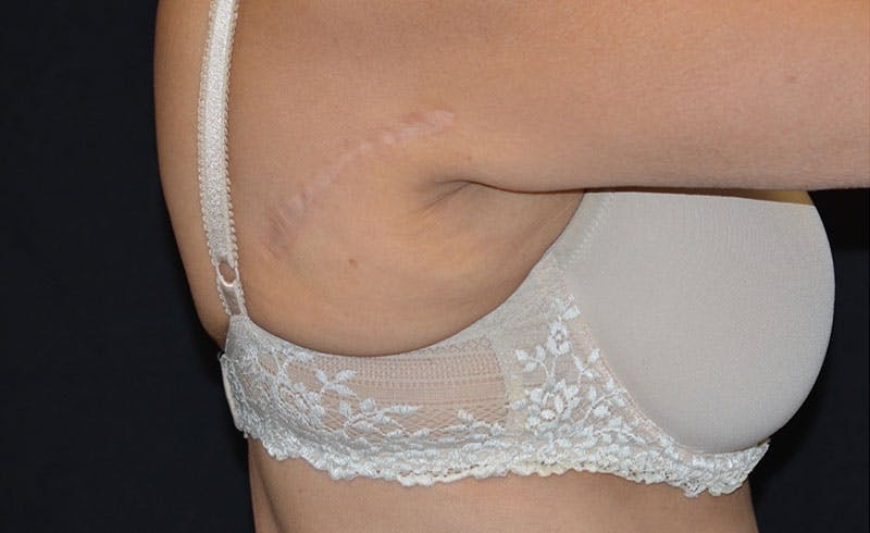 Bra Line Before & After Gallery - Patient 326532 - Image 2