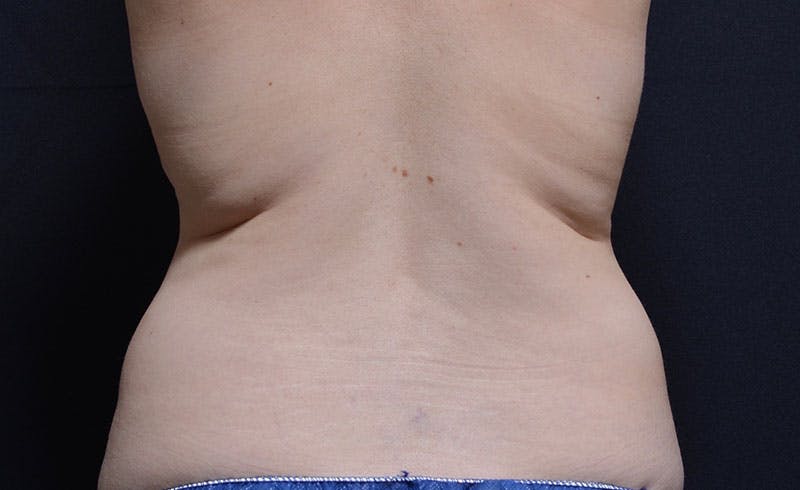 Bra Line Before & After Gallery - Patient 279265 - Image 1
