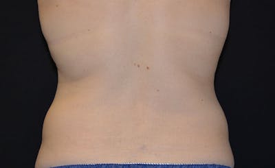 Bra Line Before & After Gallery - Patient 279265 - Image 2