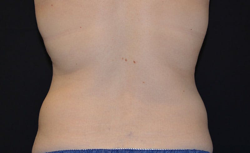 Bra Line Before & After Gallery - Patient 279265 - Image 2