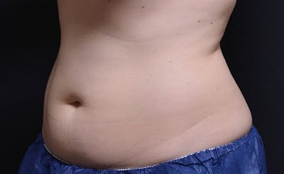 Female Abs Before & After Gallery - Patient 249444 - Image 1