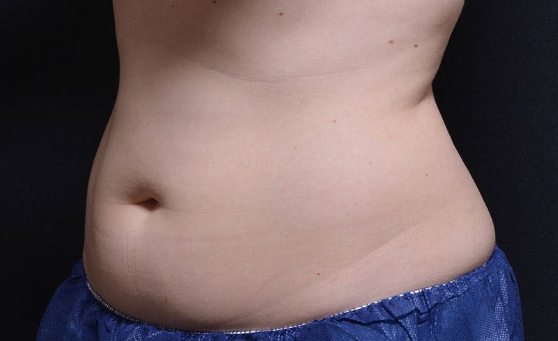 Female Abs Before & After Gallery - Patient 249444 - Image 1