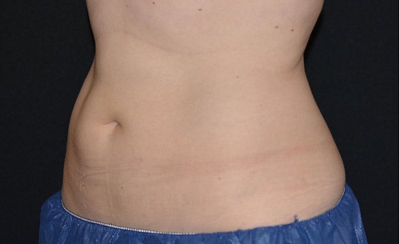 Female Abs Before & After Gallery - Patient 249444 - Image 2