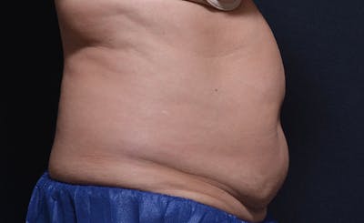 Female Abs Before & After Gallery - Patient 137026 - Image 1