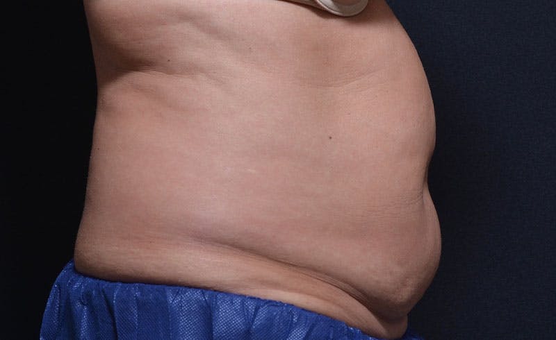 Female Abs Before & After Gallery - Patient 137026 - Image 1