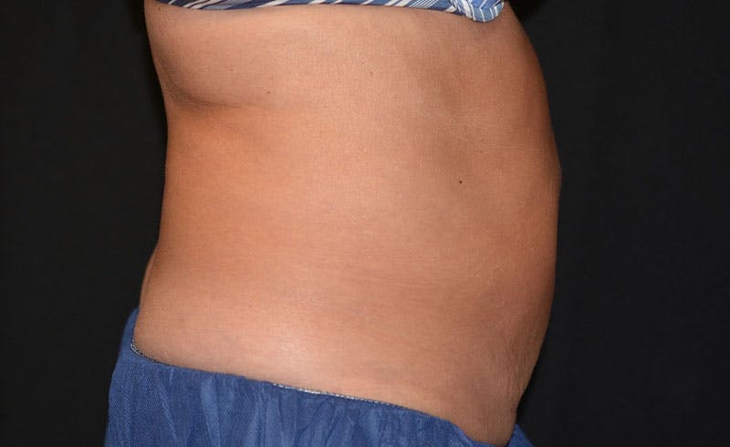Female Abs Before & After Gallery - Patient 137026 - Image 2