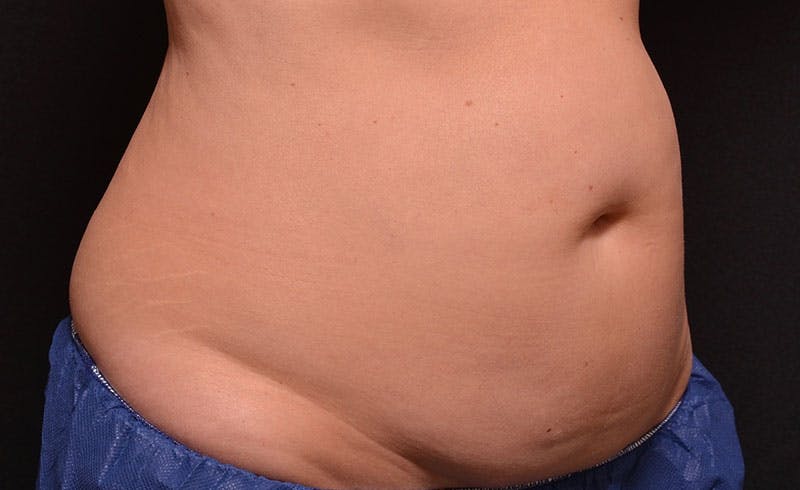 Female Abs Before & After Gallery - Patient 158247 - Image 1