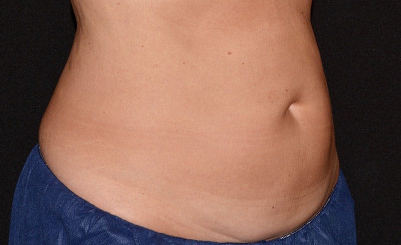 Female Abs Before & After Gallery - Patient 158247 - Image 2