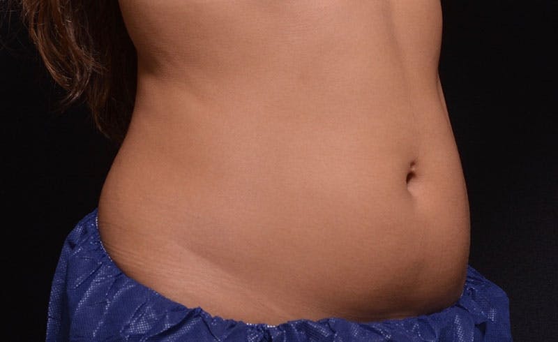 Female Abs Before & After Gallery - Patient 369503 - Image 1