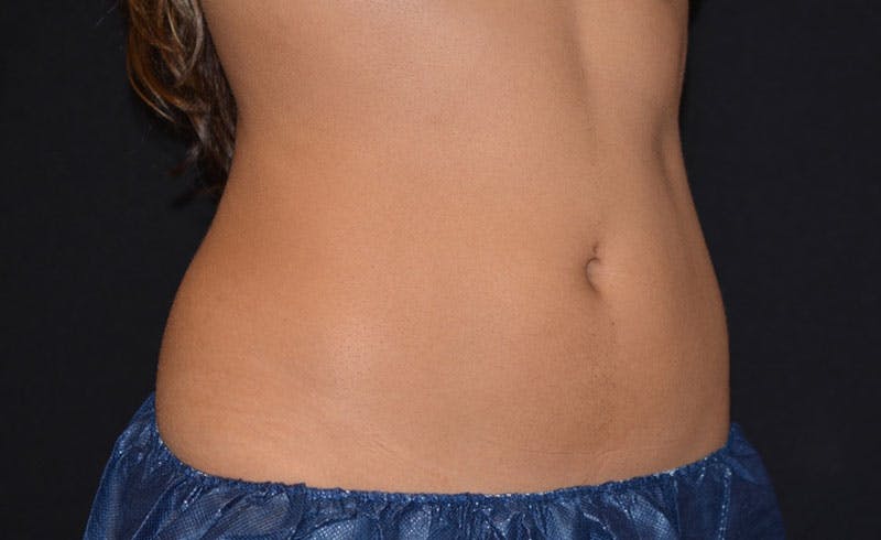 Female Abs Before & After Gallery - Patient 369503 - Image 2