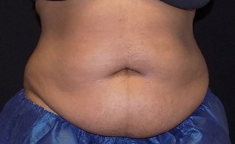 Female Abs Before & After Gallery - Patient 784747 - Image 1