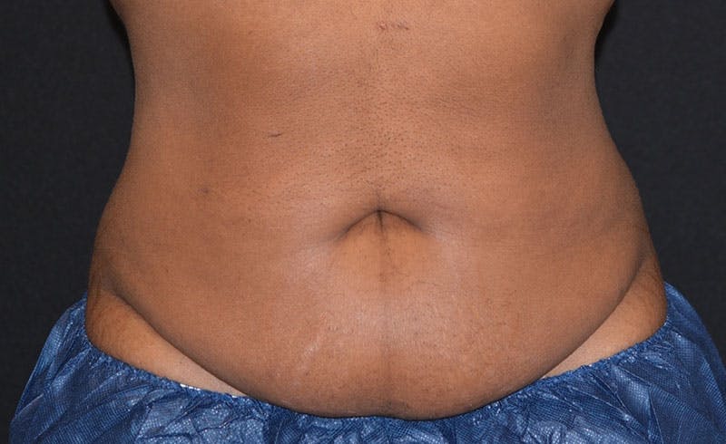 Female Abs Before & After Gallery - Patient 784747 - Image 2