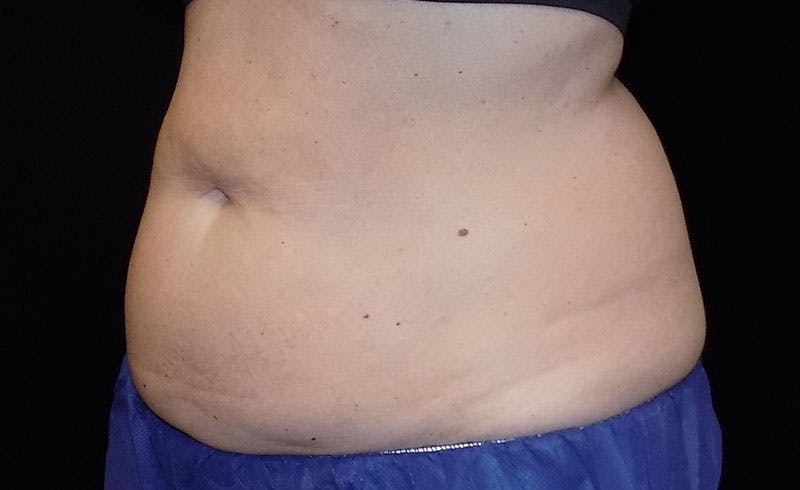 Female Abs Before & After Gallery - Patient 248051 - Image 1