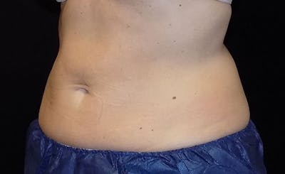 Female Abs Before & After Gallery - Patient 248051 - Image 2