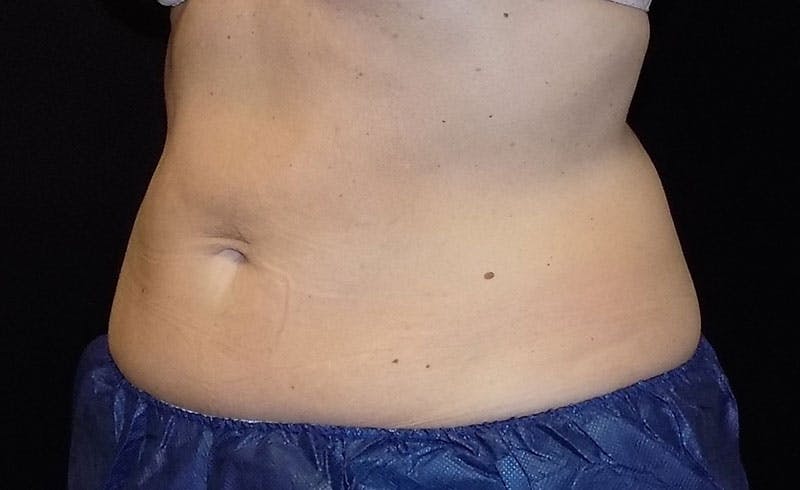 Female Abs Before & After Gallery - Patient 248051 - Image 2