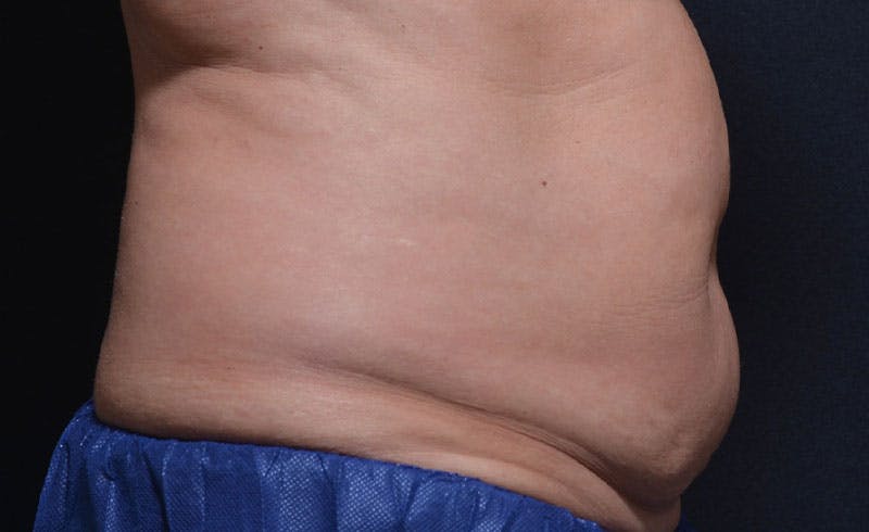 Female Abs Before & After Gallery - Patient 240928 - Image 1