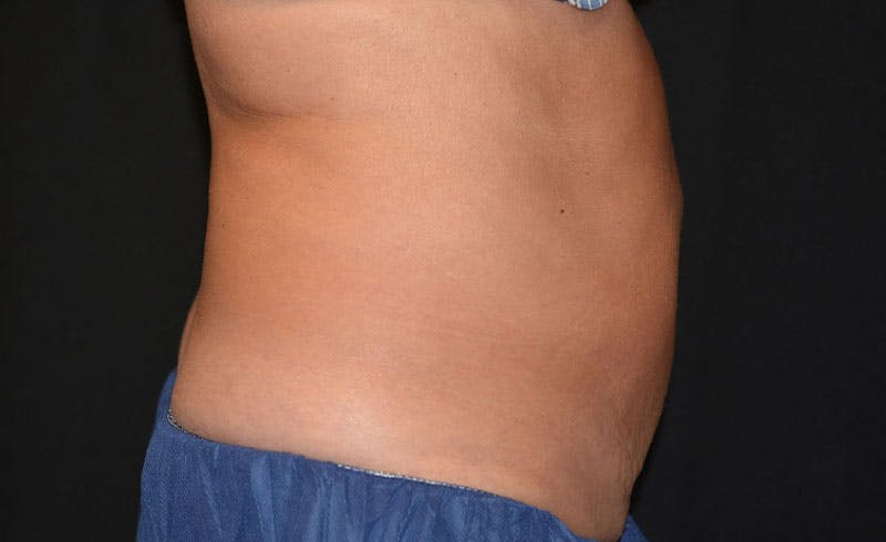 Female Abs Before & After Gallery - Patient 240928 - Image 2
