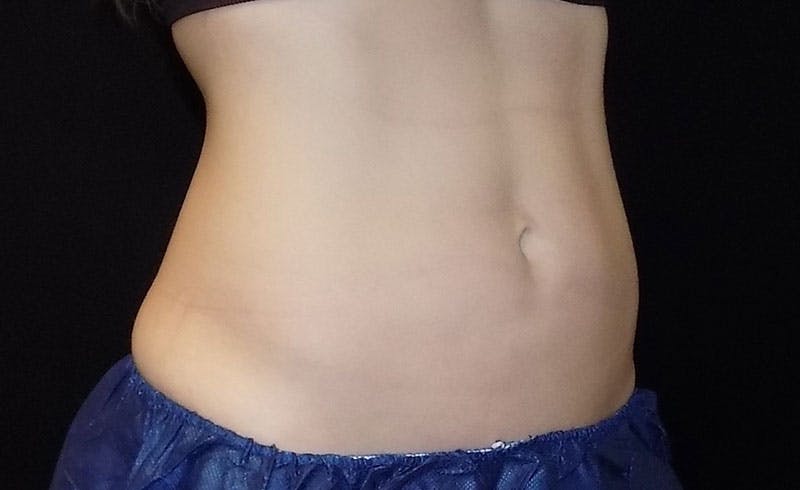 Female Abs Before & After Gallery - Patient 958630 - Image 2