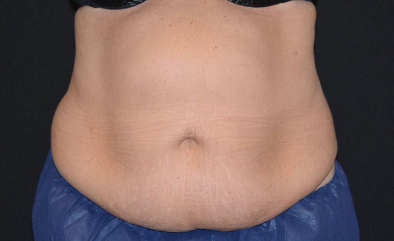 Female Abs Before & After Gallery - Patient 204237 - Image 1