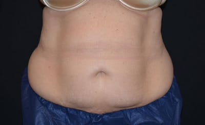 Female Abs Before & After Gallery - Patient 204237 - Image 2