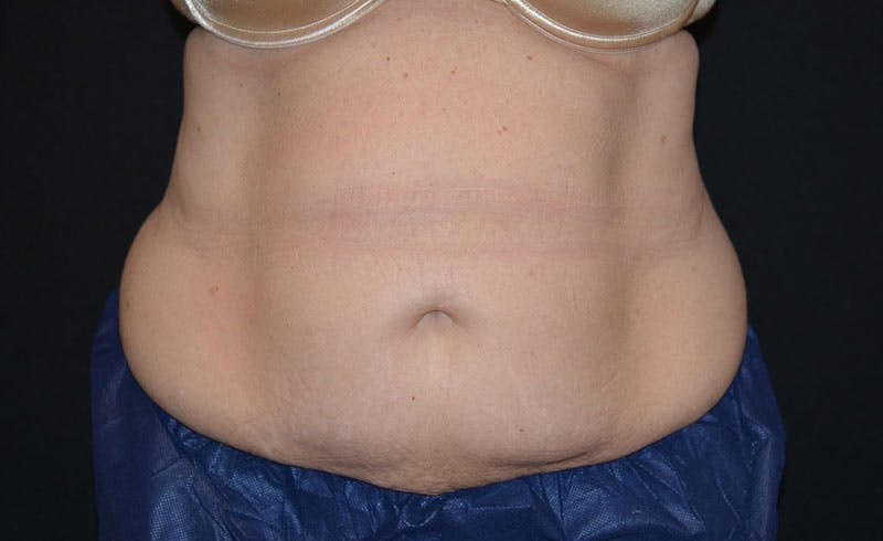 Female Abs Before & After Gallery - Patient 204237 - Image 2