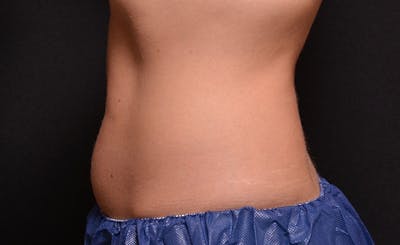 Female Abs Before & After Gallery - Patient 384586 - Image 1