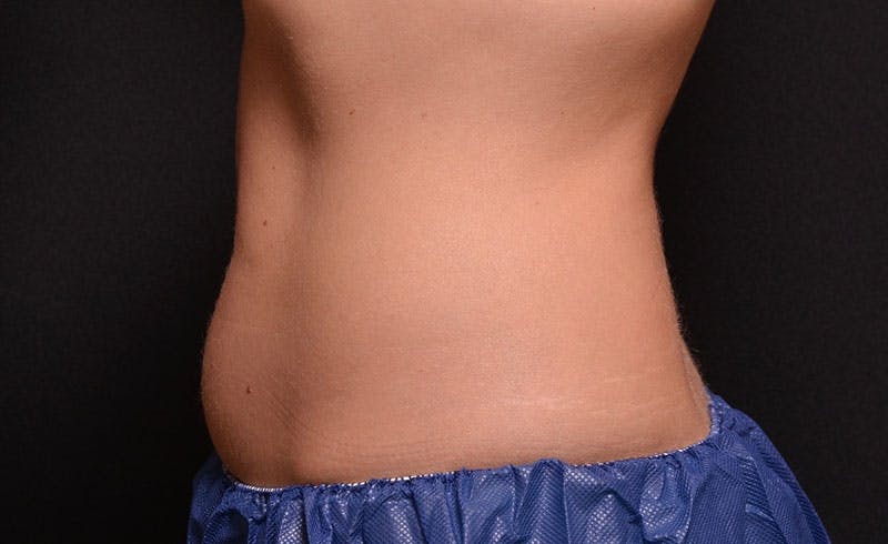 Female Abs Before & After Gallery - Patient 384586 - Image 1