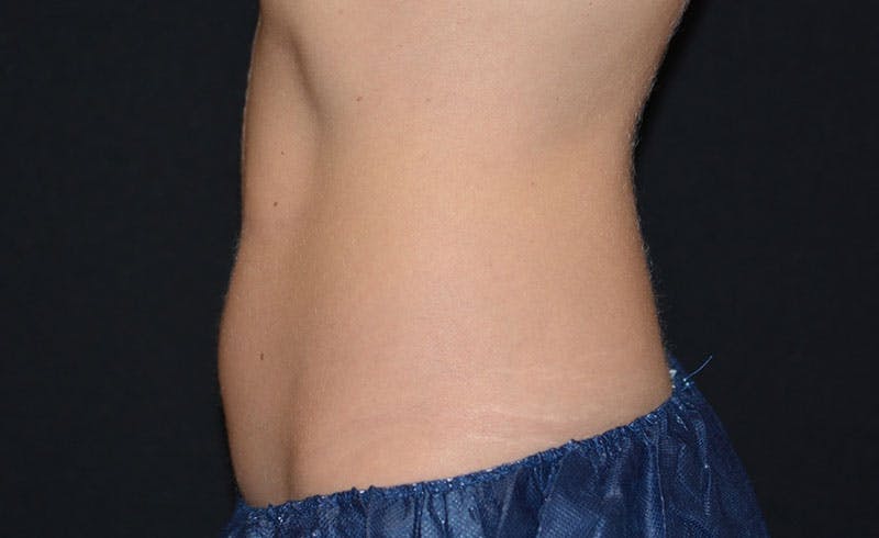 Female Abs Before & After Gallery - Patient 384586 - Image 2