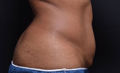 Female Abs Before & After Gallery - Patient 211458 - Image 1