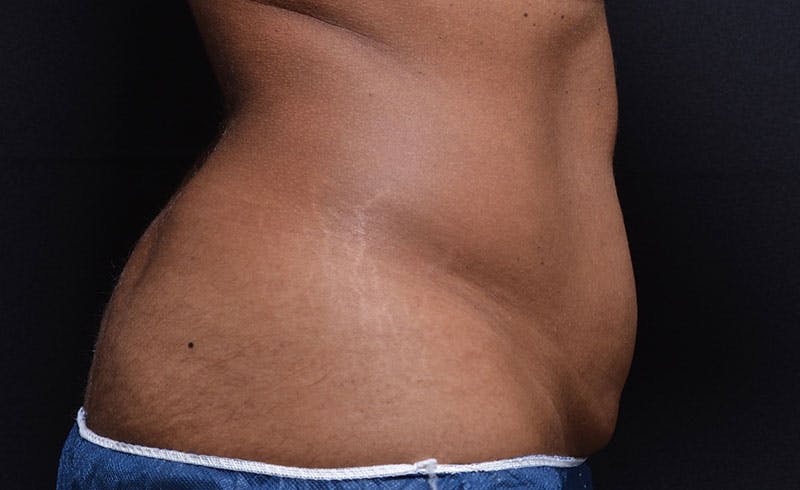 Female Abs Before & After Gallery - Patient 211458 - Image 1