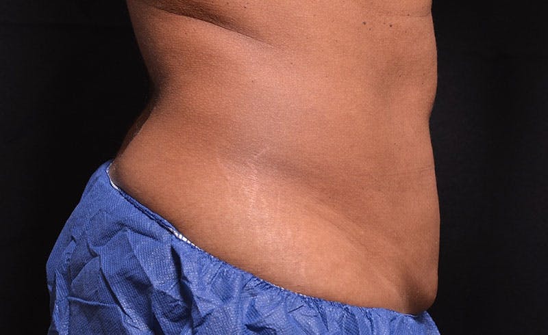 Female Abs Before & After Gallery - Patient 211458 - Image 2