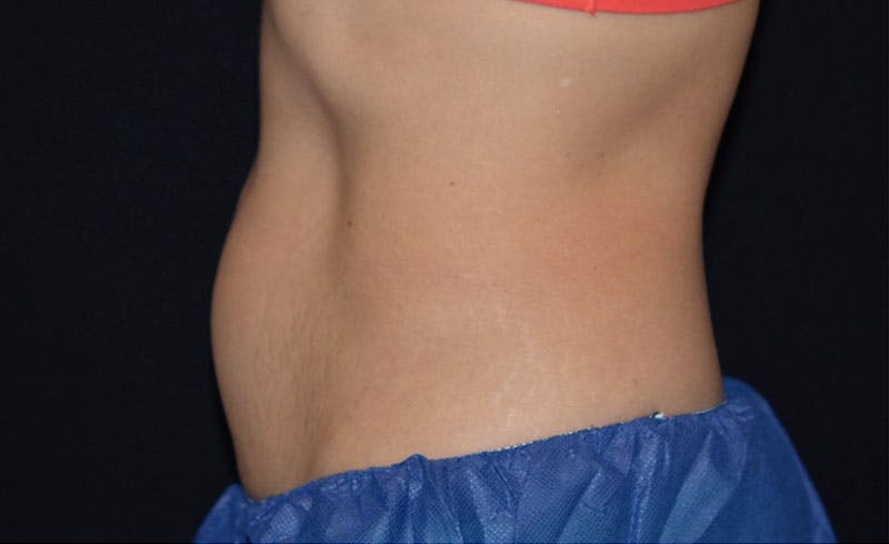 Female Abs Before & After Gallery - Patient 257304 - Image 1