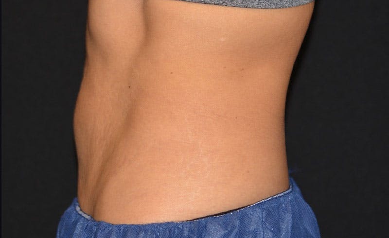 Female Abs Before & After Gallery - Patient 257304 - Image 2