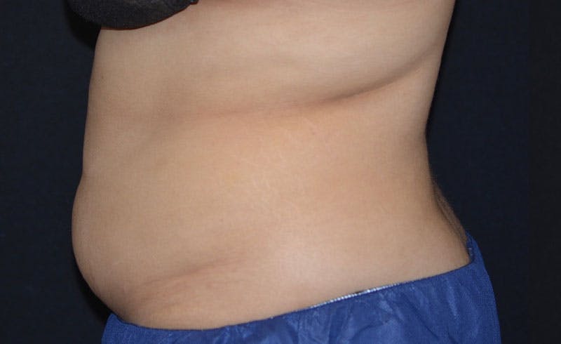 Female Abs Before & After Gallery - Patient 351624 - Image 1
