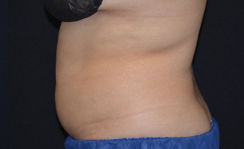 Female Abs Before & After Gallery - Patient 351624 - Image 2