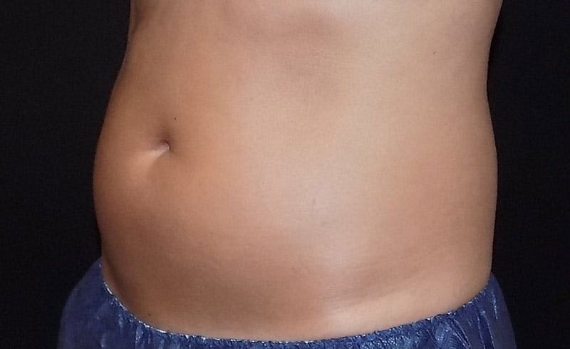 Female Abs Before & After Gallery - Patient 395299 - Image 1