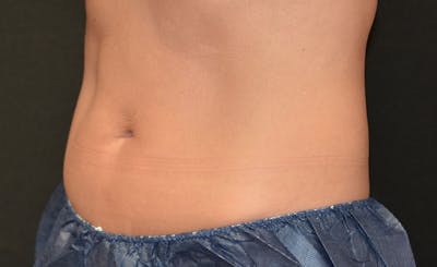 Female Abs Before & After Gallery - Patient 395299 - Image 2