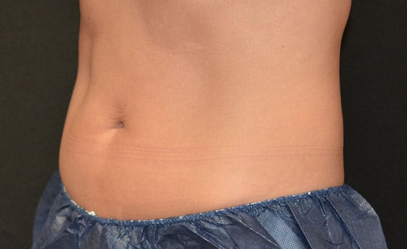 Female Abs Before & After Gallery - Patient 395299 - Image 2