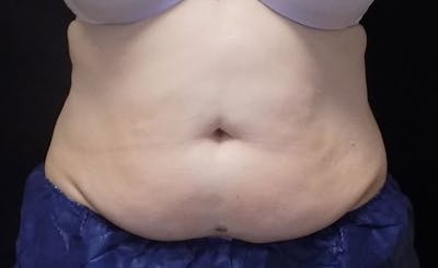 Female Abs Before & After Gallery - Patient 407268 - Image 1